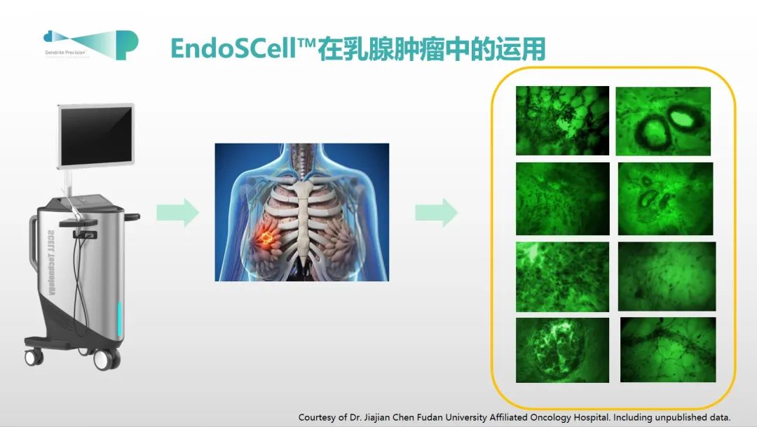 保乳手术和乳房重建术的最新强助力：术中手持显微镜EndoSCell™(图6)