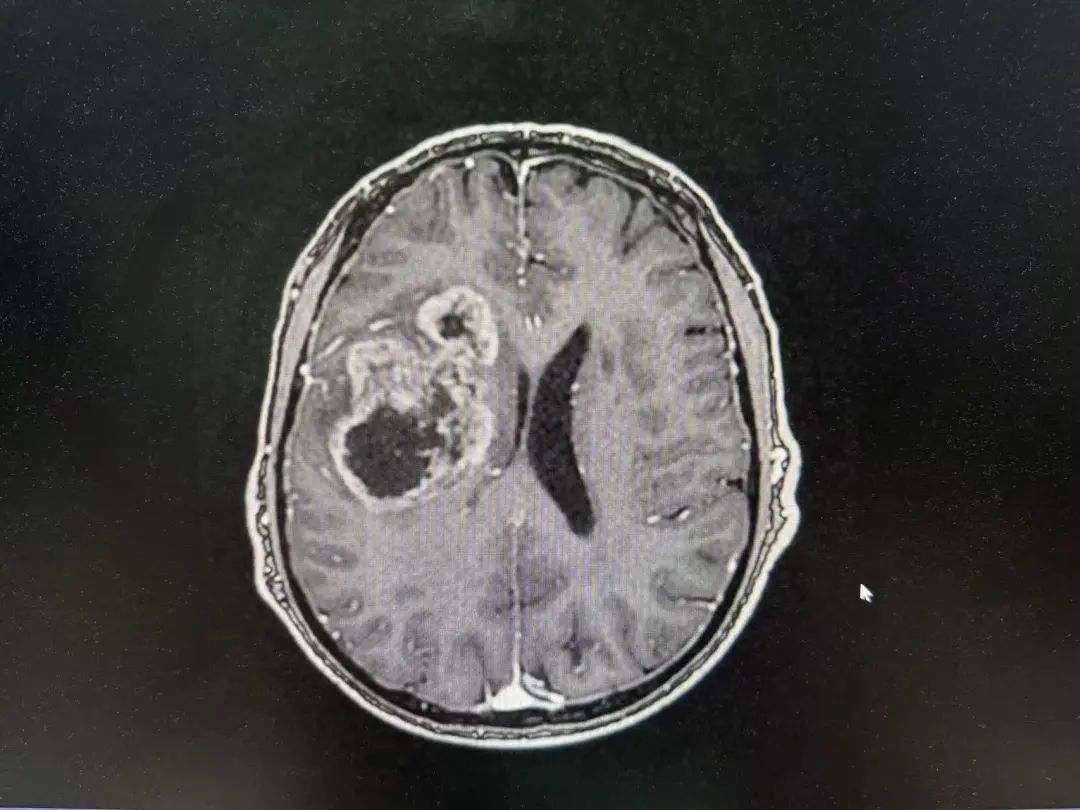 河北医大二院应用细胞级荧光导引精准技术，突破高级别胶质瘤手术的裸眼限制(图4)