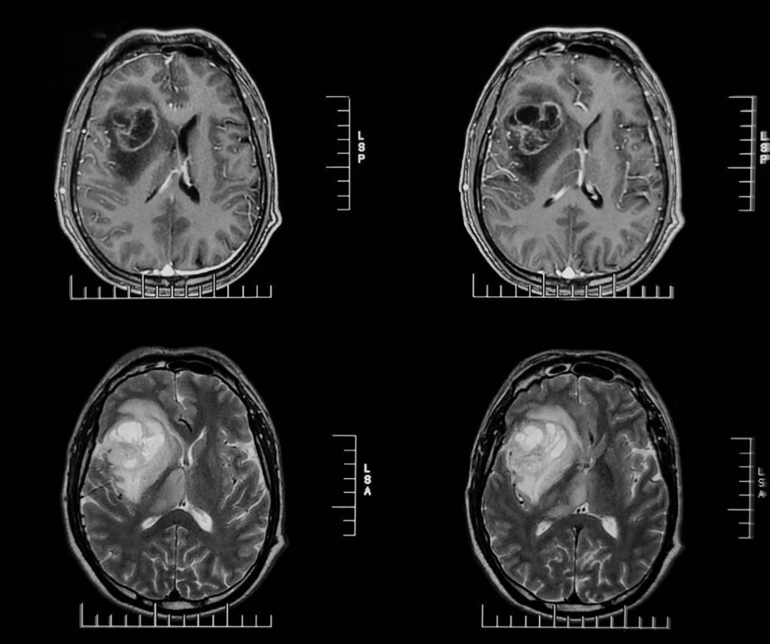 胶质母细胞瘤手术新突破：河北医大二院应用EndoSCell®实现细胞级精准切除(图2)