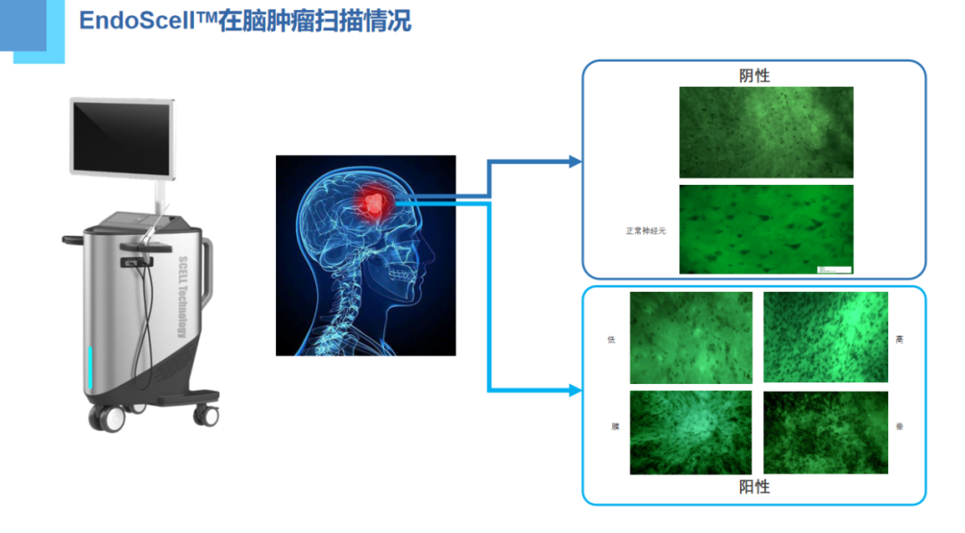 第八届华福神经外科学术会议：EndoSCell®细胞级荧光导引技术获专家认可(图3)