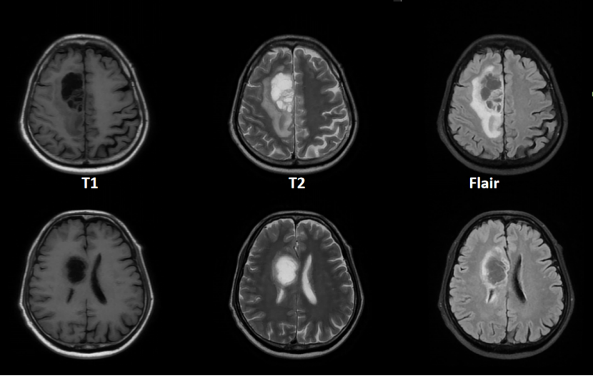 细胞级精准切除！河北医大二院应用EndoSCell®实现胶质瘤手术新突破(图3)