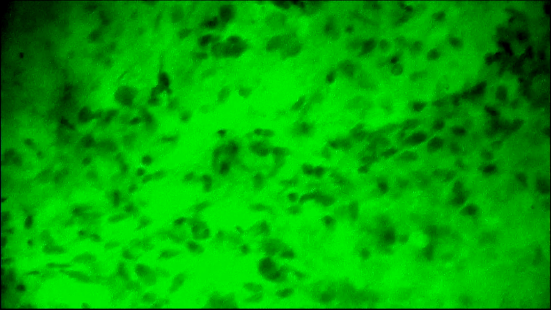 细胞级精准切除！河北医大二院应用EndoSCell®实现胶质瘤手术新突破(图7)